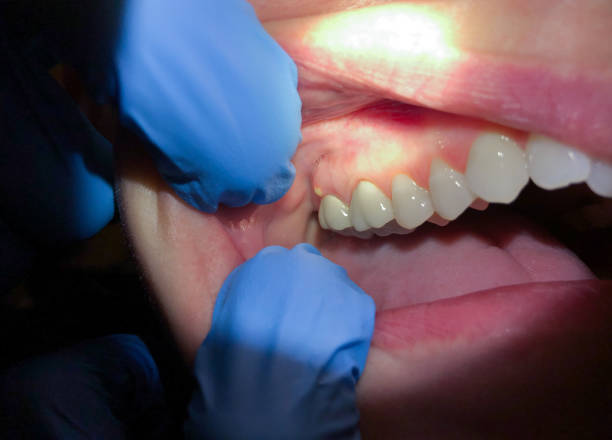 Best Emergency Wisdom Teeth Removal in Lincoln, NE